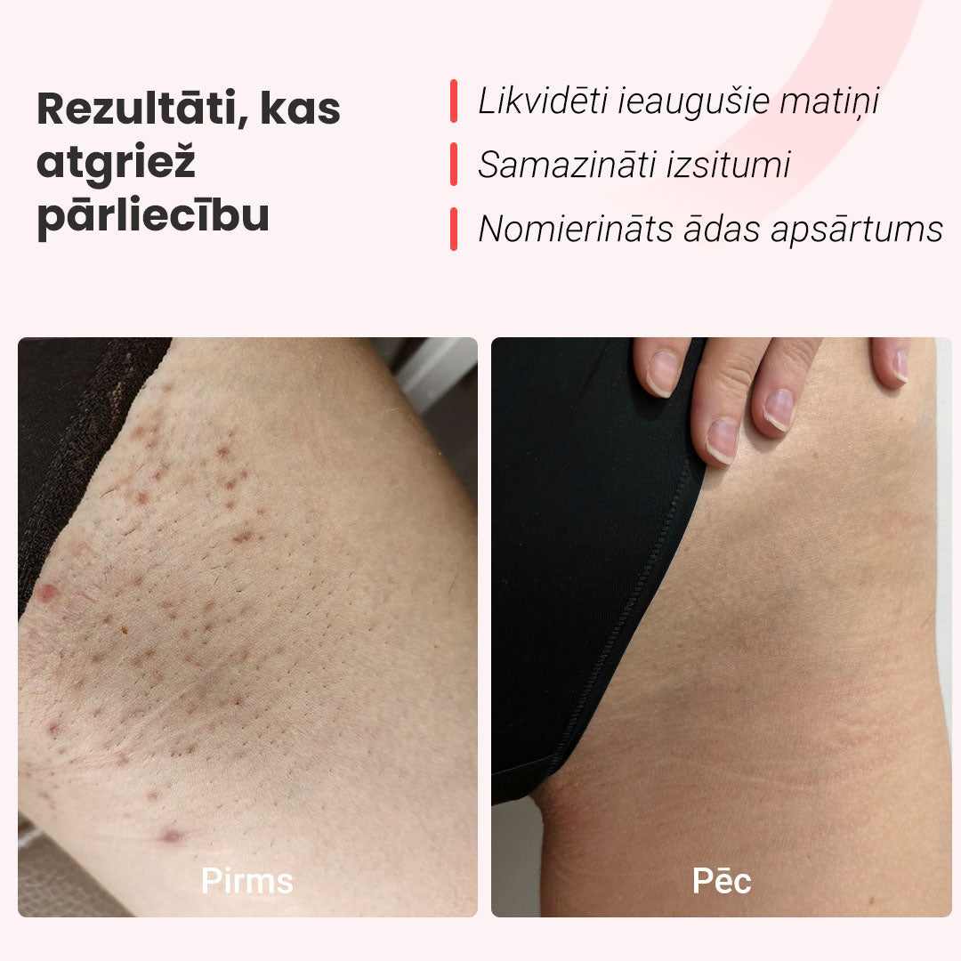Fotoepilatori IPL®